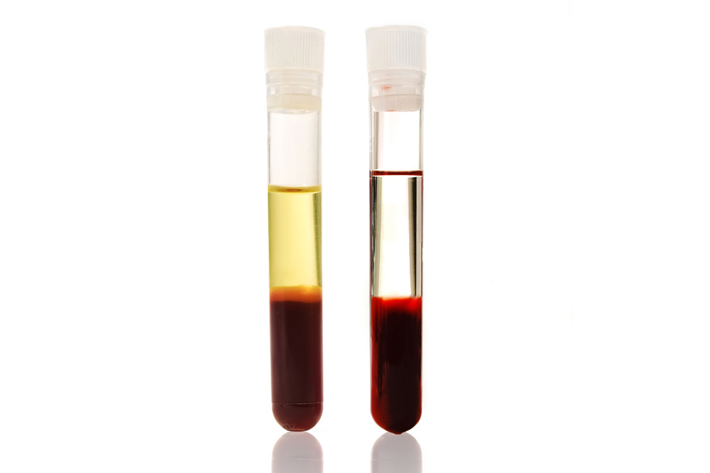 Venus Aesthetics & Skin – PRP Platelet Rich Plasma PRF Platelet Rich ...